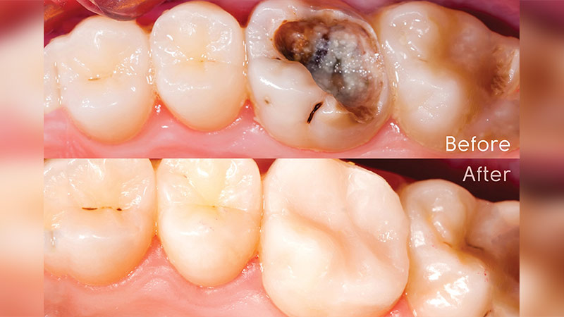 Prima e Dopo otturazione Dentale