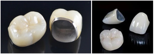 Protesi dentaria 5 corone in metallo ceramica