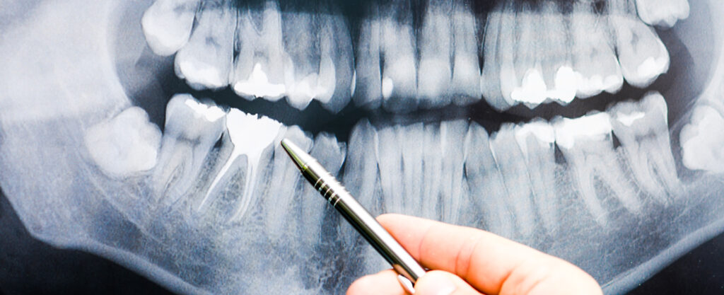 Endodonzia 3 endodonzia immagine rx