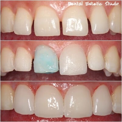 Protesi dentaria 6 faccette estetiche