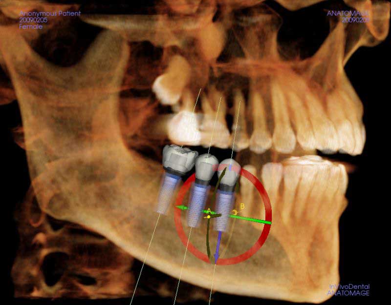 Radiologia tridimensionale Cone Beam 3D 4 iCat Dental Implant Placement