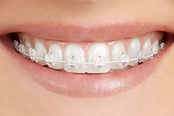 Ortodonzia 3 ortodonzia estetica con brackets in ceramica