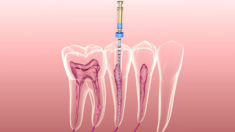 Endodonzia, conosciuta anche come cura canalare