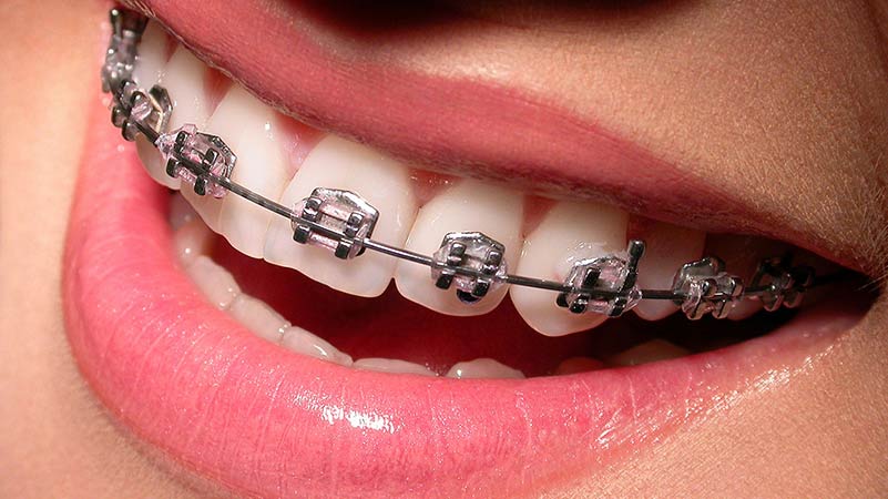 Ortodonzia con bracket